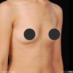Breast Augmentation Before & After Patient #2758