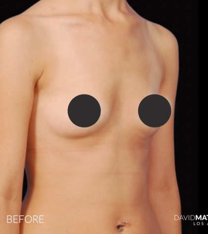 Breast Augmentation Before & After Patient #2758