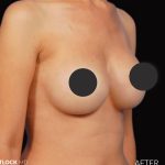 Breast Augmentation Before & After Patient #2758