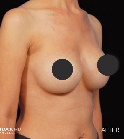 Breast Augmentation Before & After Patient #2758