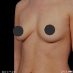 Breast Augmentation Before & After Patient #2759
