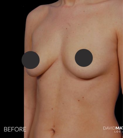Breast Augmentation Before & After Patient #2759