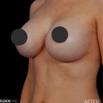 Breast Augmentation Before & After Patient #2759