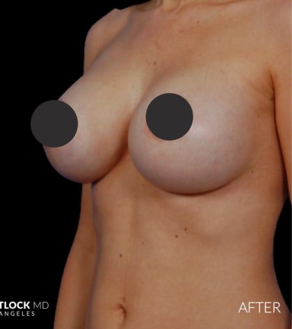 Breast Augmentation Before & After Patient #2759