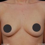Breast Augmentation Before & After Patient #2759