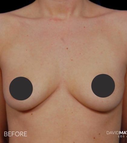Breast Augmentation Before & After Patient #2759