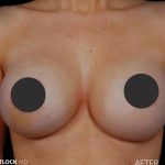 Breast Augmentation Before & After Patient #2759