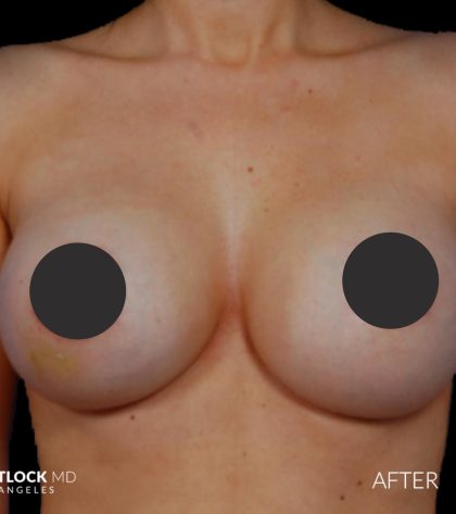 Breast Augmentation Before & After Patient #2759