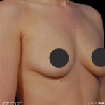 Breast Augmentation Before & After Patient #2759