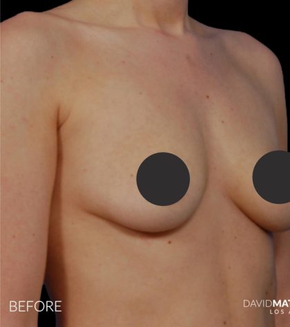 Breast Augmentation Before & After Patient #2759