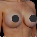 Breast Augmentation Before & After Patient #2759