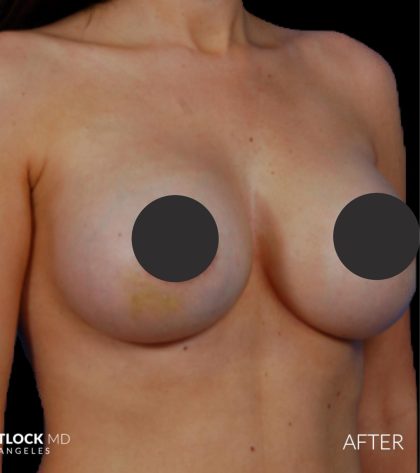 Breast Augmentation Before & After Patient #2759