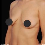 Breast Augmentation Before & After Patient #2760