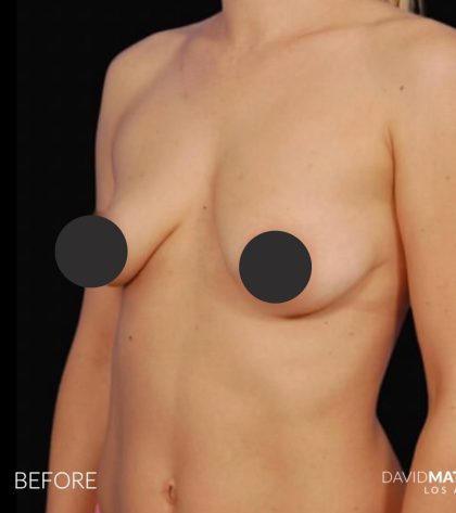 Breast Augmentation Before & After Patient #2760