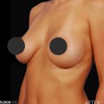 Breast Augmentation Before & After Patient #2760