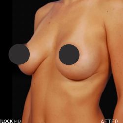 Breast Augmentation Before & After Patient #2760