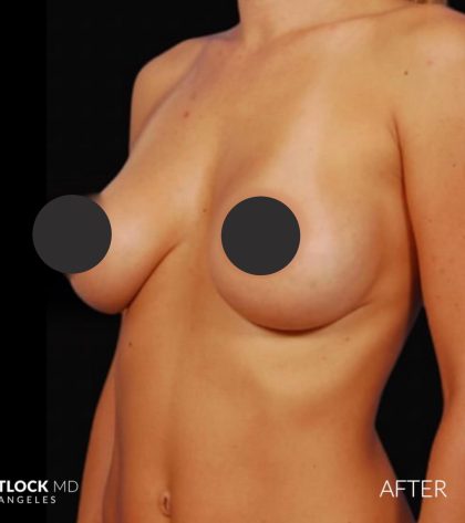 Breast Augmentation Before & After Patient #2760