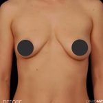 Breast Augmentation Before & After Patient #2760