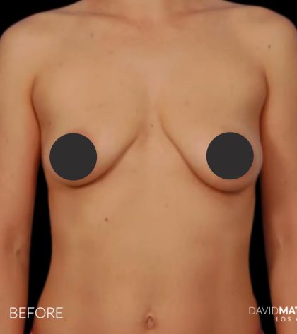 Breast Augmentation Before & After Patient #2760