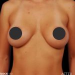 Breast Augmentation Before & After Patient #2760