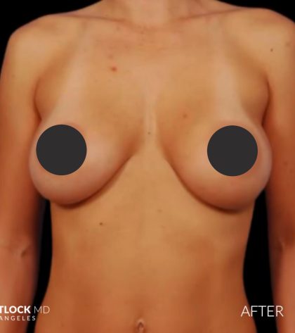 Breast Augmentation Before & After Patient #2760