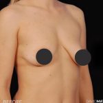 Breast Augmentation Before & After Patient #2760