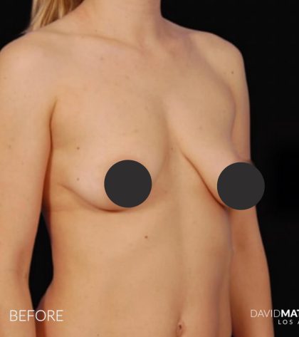 Breast Augmentation Before & After Patient #2760