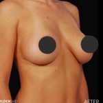 Breast Augmentation Before & After Patient #2760