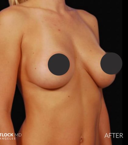 Breast Augmentation Before & After Patient #2760