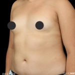 Breast Augmentation Before & After Patient #2761
