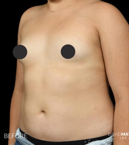Breast Augmentation Before & After Patient #2761