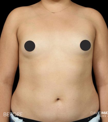 Breast Augmentation Before & After Patient #2761
