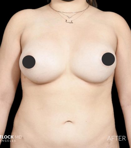 Breast Augmentation Before & After Patient #2761