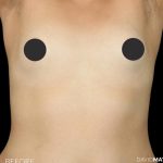 Breast Augmentation Before & After Patient #2761