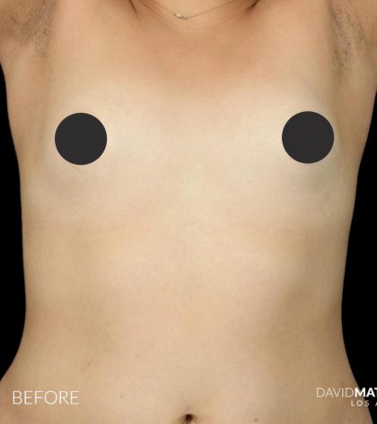 Breast Augmentation Before & After Patient #2761