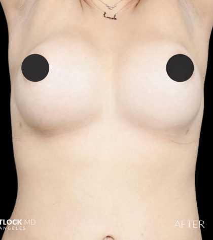 Breast Augmentation Before & After Patient #2761