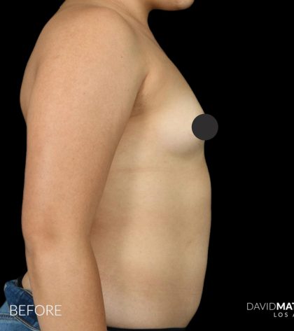 Breast Augmentation Before & After Patient #2761