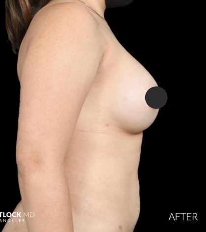 Breast Augmentation Before & After Patient #2761