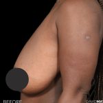 Breast Lift Before & After Patient #2763