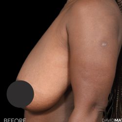 Breast Lift Before & After Patient #2763