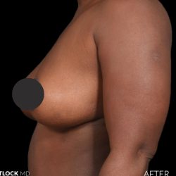 Breast Lift Before & After Patient #2763