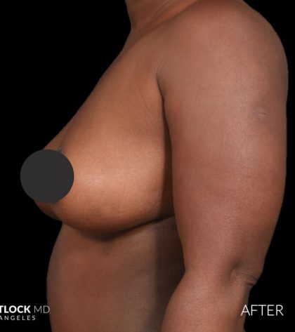 Breast Lift Before & After Patient #2763