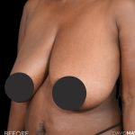 Breast Lift Before & After Patient #2763