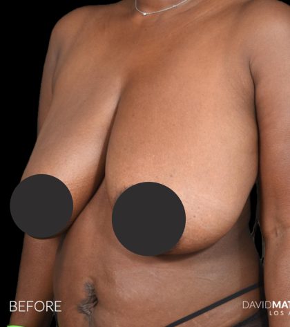 Breast Lift Before & After Patient #2763
