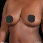 Breast Lift Before & After Patient #2763