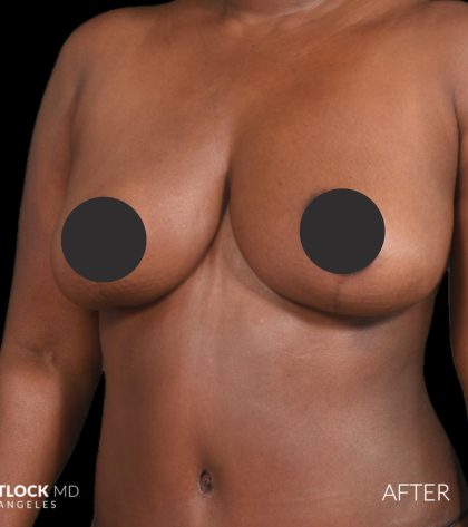 Breast Lift Before & After Patient #2763