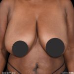 Breast Lift Before & After Patient #2763