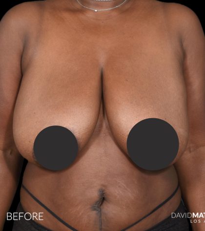 Breast Lift Before & After Patient #2763