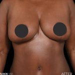 Breast Lift Before & After Patient #2763