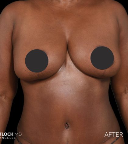Breast Lift Before & After Patient #2763